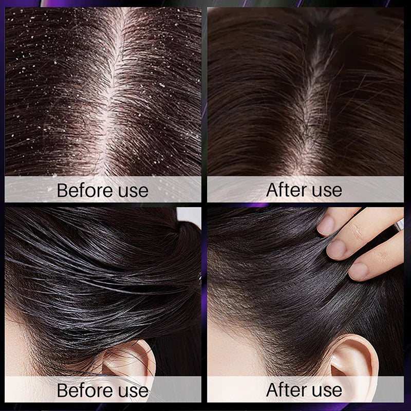 Rosemary & Onion Hair Growth Shampoo - Deep Cleansing Volumizing Formula for