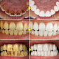 5 Days Teeth Whitening Powder Remove Plaque Stains Dental Calculus Oral Hygiene